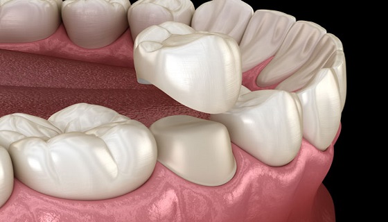 Root Canal Treatment