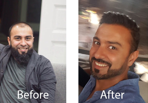 hair transplant uk