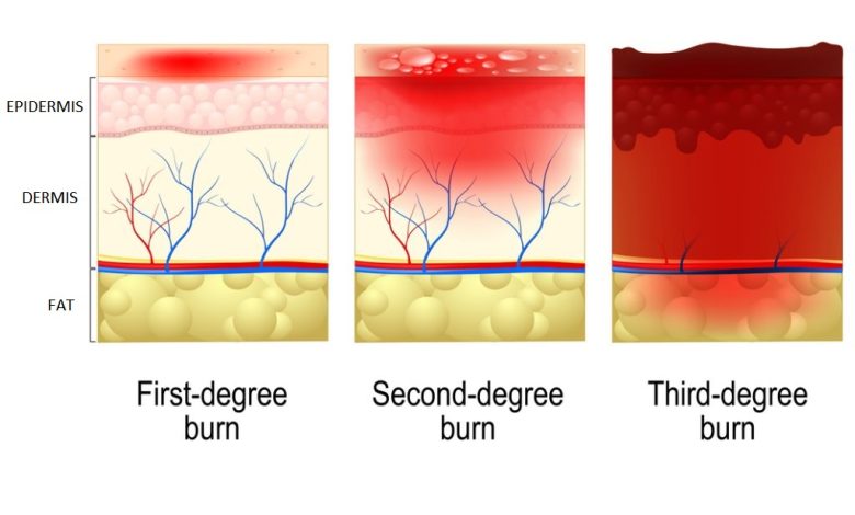 skin burn