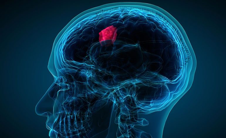 symptoms of brain tumor