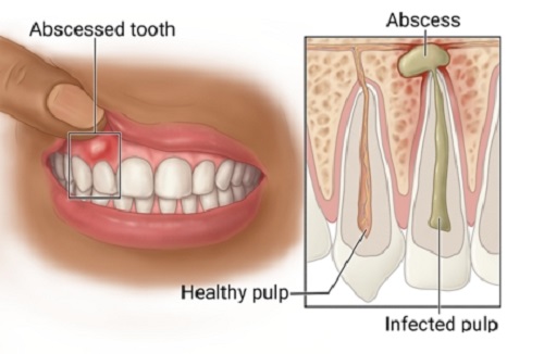 tooth abscess pain relief fast